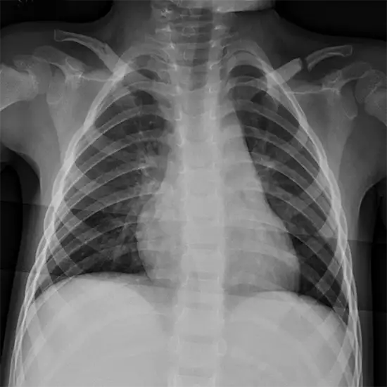 x-ray both clavicle test